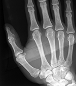 Hand radiograph as an imaging finding in age estimation