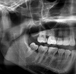 Orthopantomogram as an imaging finding in age estimation