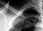 Clavicle finding as a supplementary imaging finding